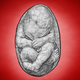 Image for article titled A History of Lithopedions: When a Fetus Turns to Stone